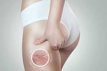 Emtone Cellulite Reduction Willowbrook IL